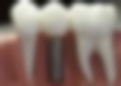 韩国奥齿泰属于什么档次？属于中高端档次性价比深得患者认可