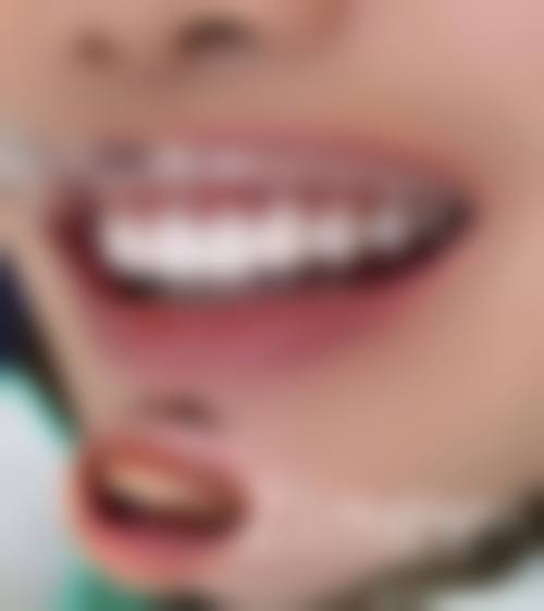 深圳麦芽口腔医院需要提前挂号，但我去做的全口牙齿美白效果是真的赞