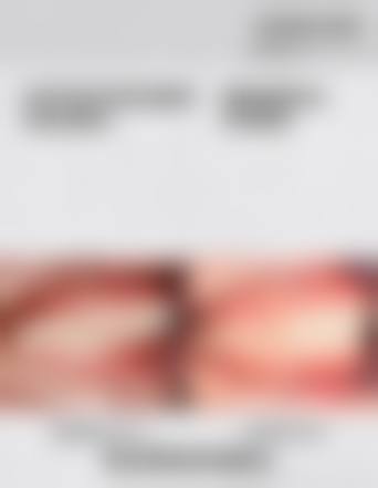 临床实例分享:昆山市玉山镇嘉丽口腔苗利利成效如何?
