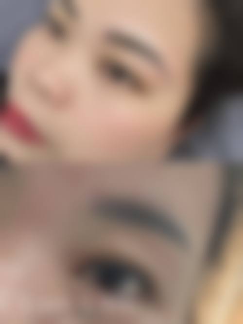 临床实例分享:南通市崇川区蝶美莎医疗美容门诊部黄忠的真实反馈