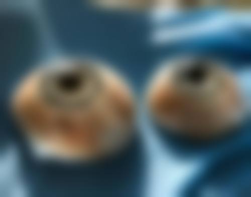 预约优惠活动:哈尔滨焦视眼科医院张蔓的专属补贴